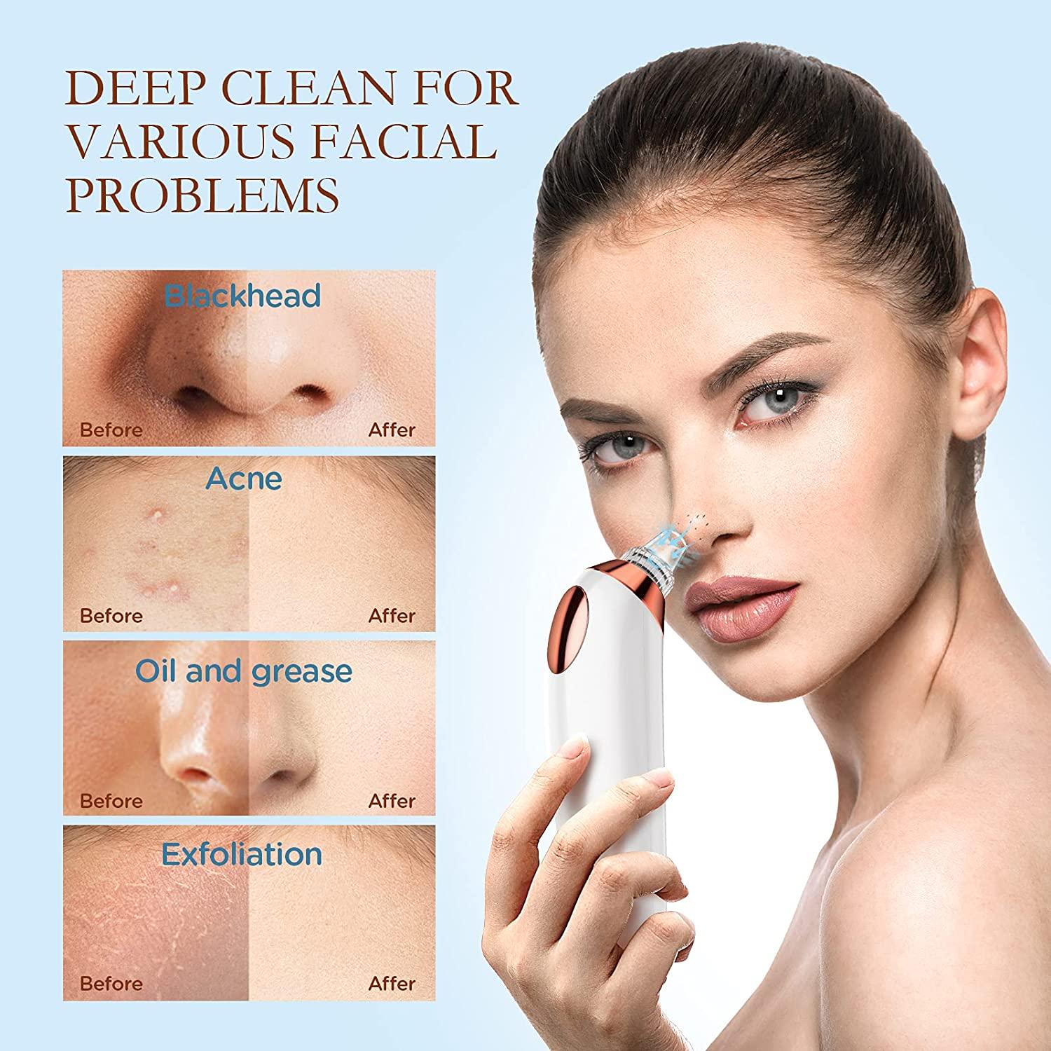 5-in-1 Electric Blackhead Remover Vacuum